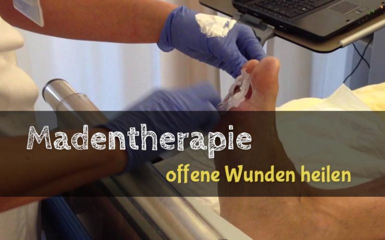 Madentherapie – Wunden heilen besser als mit Antibiotika