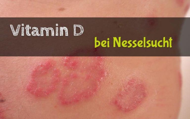 Chronische Nesselsucht? Vitamin D kann helfen